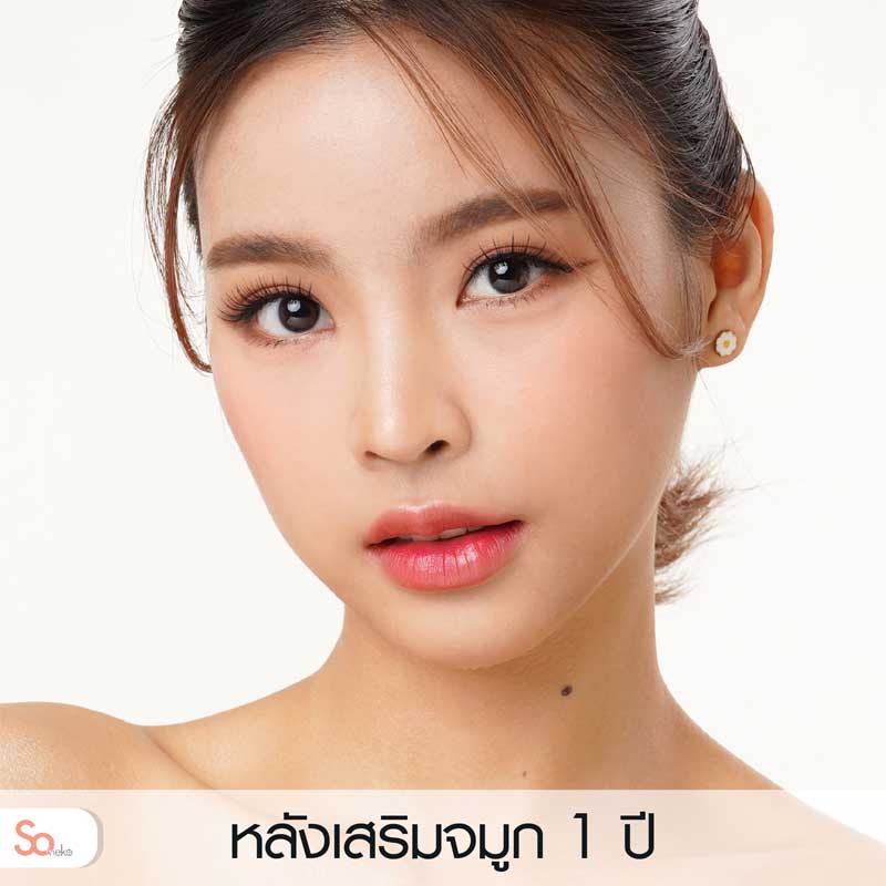 อินหลังเสริมจมูก 1 ปี