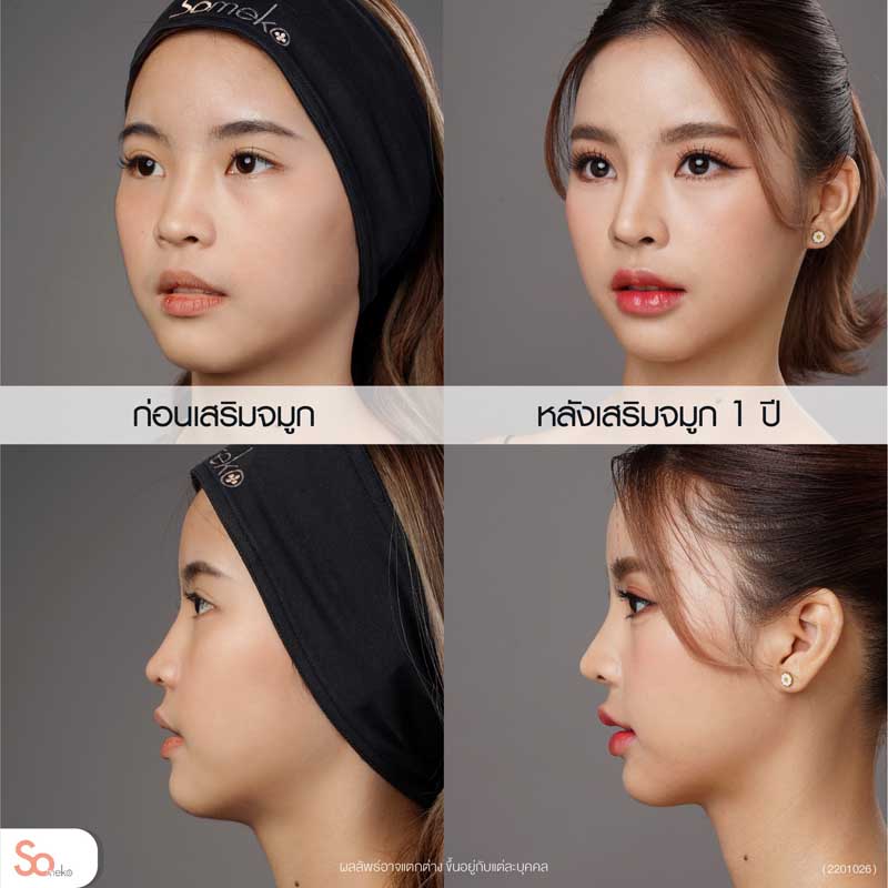 อินก่อนและหลังเสริมจมูกด้านข้าง