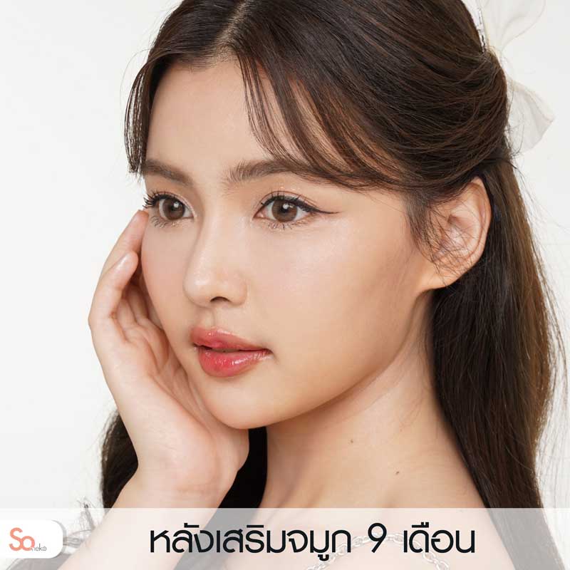 ไข่มุกหลังเสริมจมูก 9 เดือน รูปที่ 2