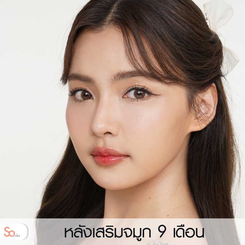 ไข่มุกหลังเสริมจมูก 9 เดือน รูปที่ 3