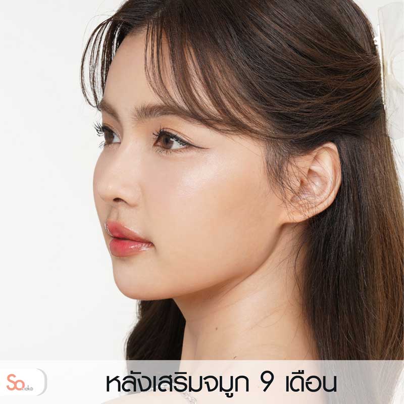 ไข่มุกหลังเสริมจมูก 9 เดือน