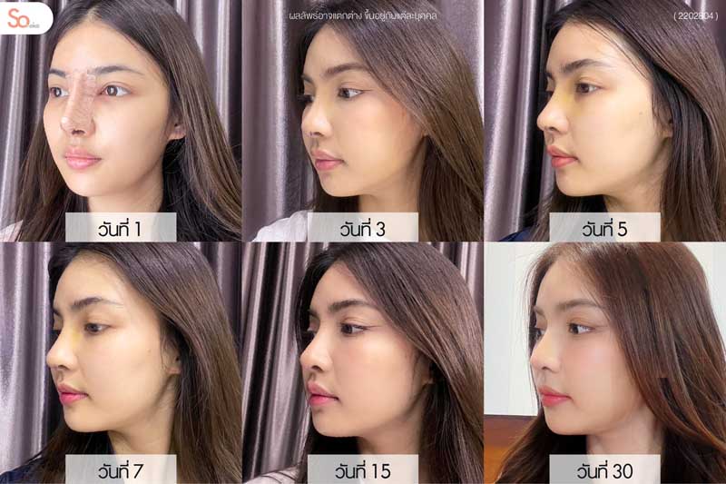 ไข่มุกหลังเสริมจมูกรายวัน