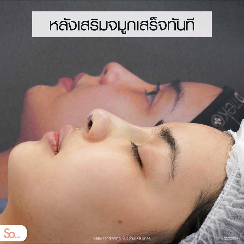 ไข่มุกหลังเสริมจมูกเสร็จทันที