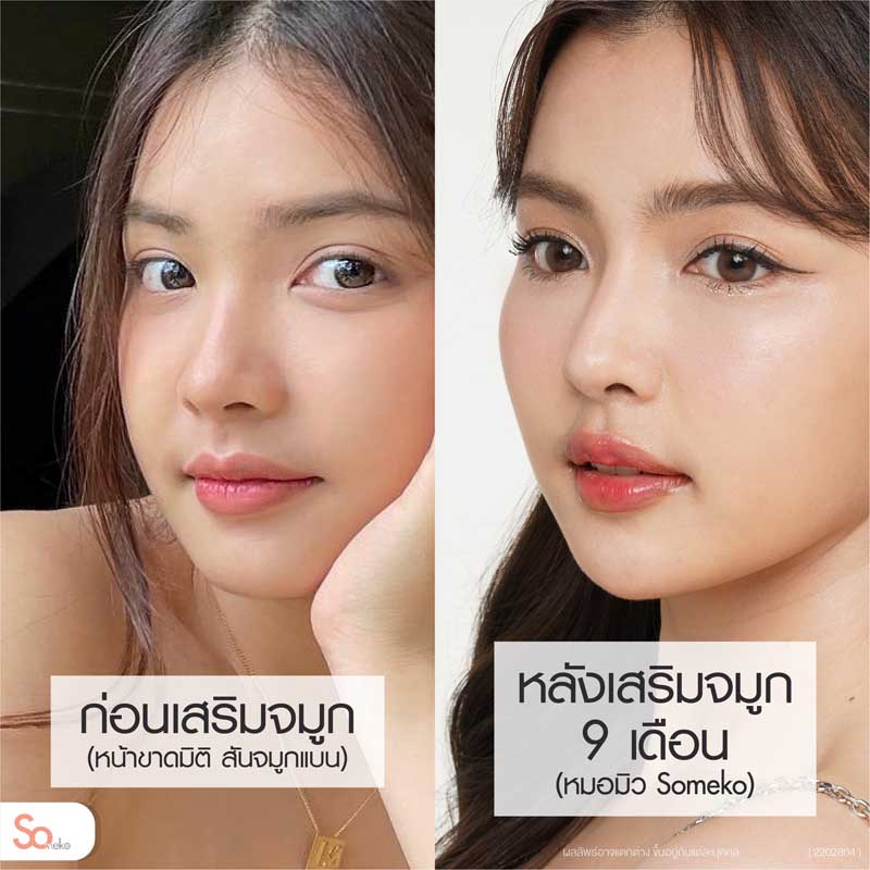 ไข่มุกก่อนและหลังเสริมจมูก 9 เดือน รูปที่ 2