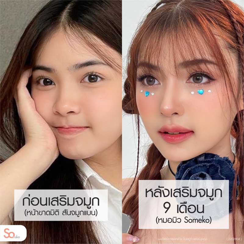 ไข่มุกก่อนและหลังเสริมจมูก 9 เดือน