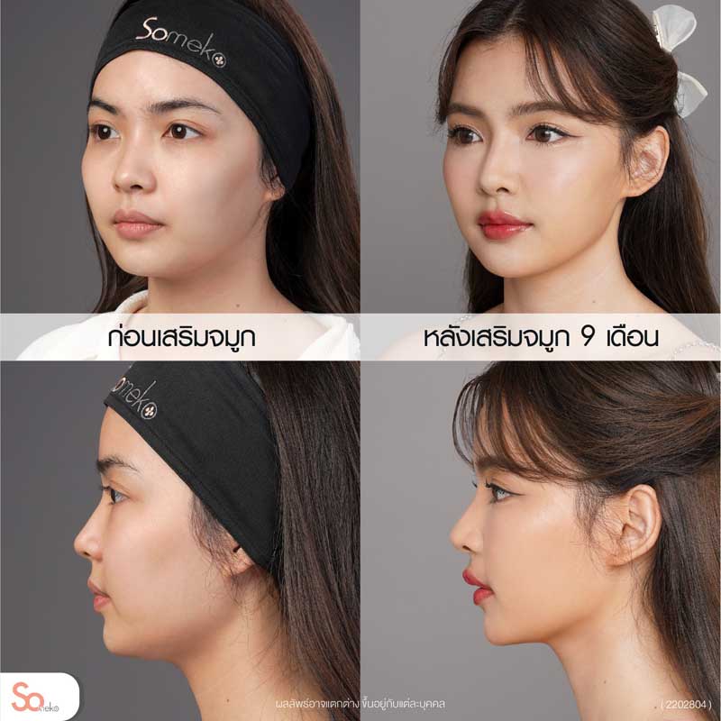 ไข่มุกก่อนและหลังเสริมจมูกด้านข้าง