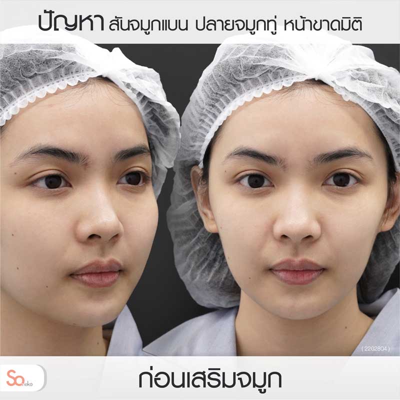 ไข่มุกก่อนเสริมจมูก