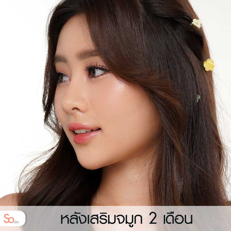 นีน่าหลังเสริมจมูก 2 เดือน รูปที่ 2