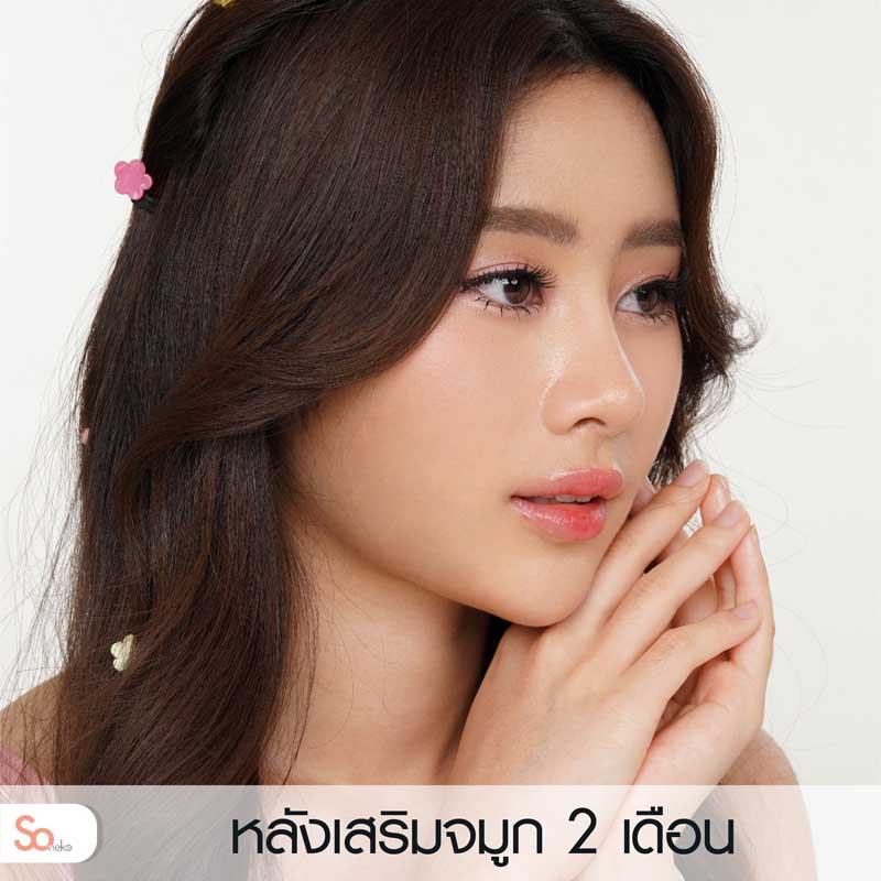 นีน่าหลังเสริมจมูก 2 เดือน รูปที่ 3