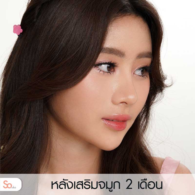 นีน่าหลังเสริมจมูก 2 เดือน