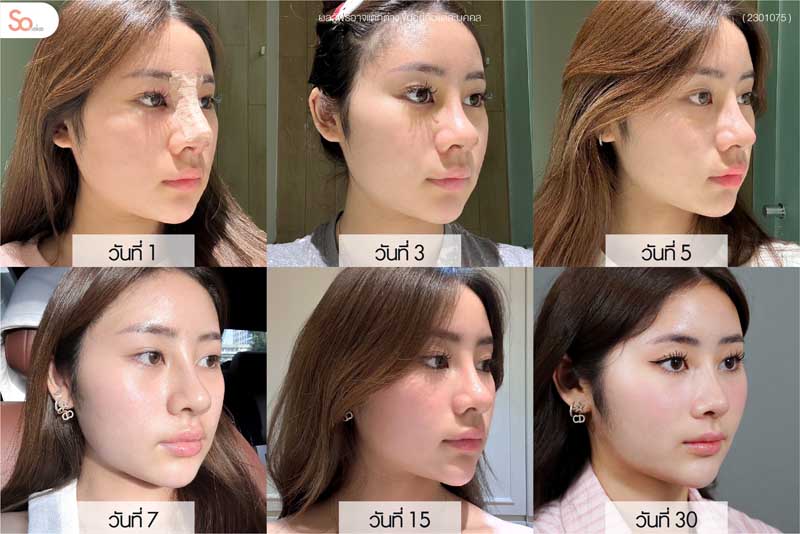 นีน่าหลังเสริมจมูกรายวัน