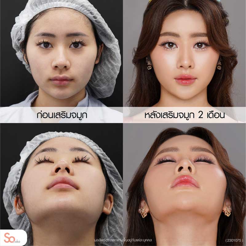 นีน่าก่อนและหลังเสริมจมูก