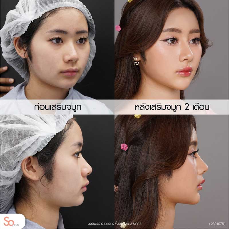 นีน่าก่อนและหลังเสริมจมูกด้านข้าง