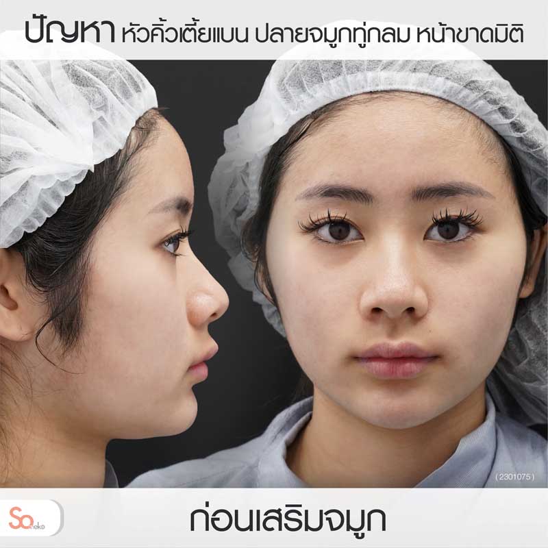 นีน่าก่อนเสริมจมูก